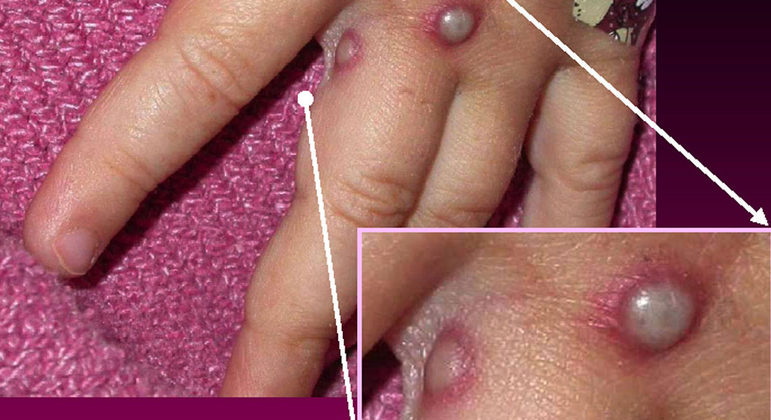 Sintoma clássico da varíola do macaco, bolhas na pele têm padrão diferente no surto atual