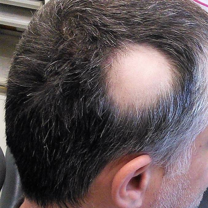 EUA aprovam remédio que fez cabelo crescer em 35% dos pacientes com tipo grave de calvície