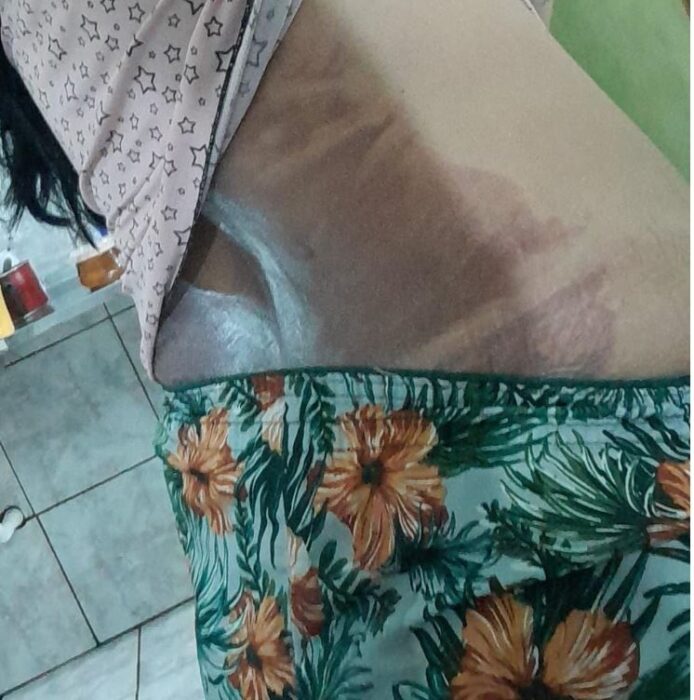 Marido joga água quente em esposa durante discussão