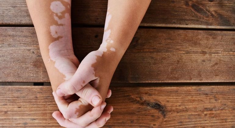 Manifestação não impõe limitação De acordo com a Associação Brasileira de Dermatologia, "pessoas que apresentam vitiligo não possuem limitações físicas ou cognitivas, não transmitem sua condição pelo contato social e estão aptas ao trabalho e ao desenvolvimento de relações afetivas e humanas em qualquer contexto". O vitiligo é uma manifestação não contagiosa, autoimune e multifatorial que tem como principal característica manchas que se espalham pela pele em decorrência de despigmentação provocada pela falta ou diminuição da melanina. Seu surgimento pode estar relacionado a predisposição genética.