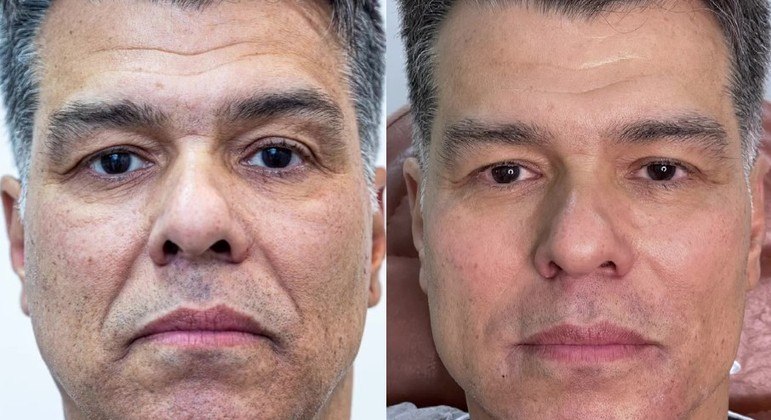 Aos 58 anos, Maurício Mattar faz harmonização facial, seu primeiro procedimento estético