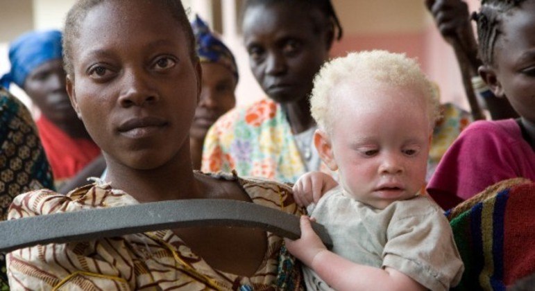 Pai é preso em Moçambique por tentar vender os três filhos albinos