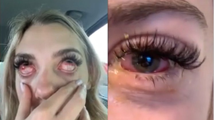 Jovem fica com 'olhos de zumbi' após fazer extensões de cílios: 'Achei que ficaria cega'