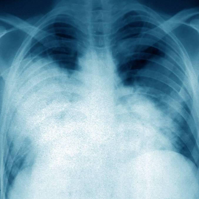 "Organismos legionella podem entrar no sistema hidráulico de um edifício por meio de fontes de água doce: o fornecimento de água de um edifício é muitas vezes a fonte de um surto de legionella. Microrganismos de legionella são incorporados em um biofilme que se forma no interior de caixas d’água e outros recipientes. A infecção normalmente é adquirida pela inalação de aerossóis (ou menos frequentemente, aspiração) da água contaminada (p. ex., como a gerada por chuveiros, banheiras de hidromassagem ou torres de resfriamento de água para ar condicionado)", descreve a publicação. O tratamento normalmente envolve a administração intravenosa de antibióticos, incluindo as fluoroquinolonas, ou azitromicina e doxiciclina, a depender da avaliação médica