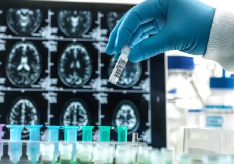 Alzheimer: Novo Remédio Retarda Declínio Mental Em 27%. ‘Mais ...