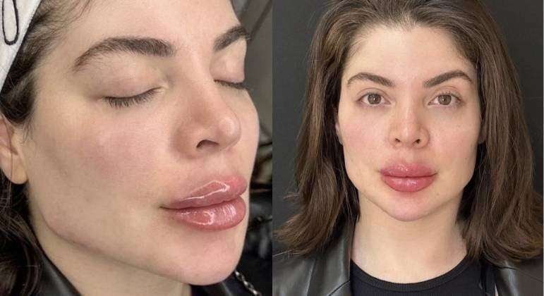 Gkay mostra resultado de nova harmonização facial e preenchimento labial