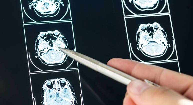 Novo remédio pode mudar o destino de pacientes com Alzheimer em estágio inicial