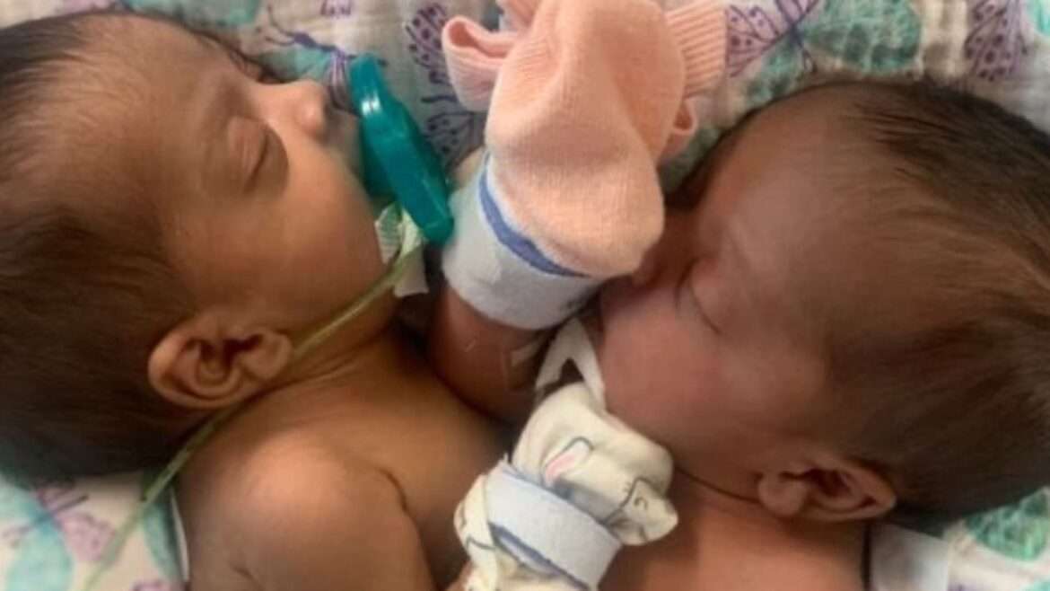 Gêmeas siamesas são separadas após operação que durou 11 horas