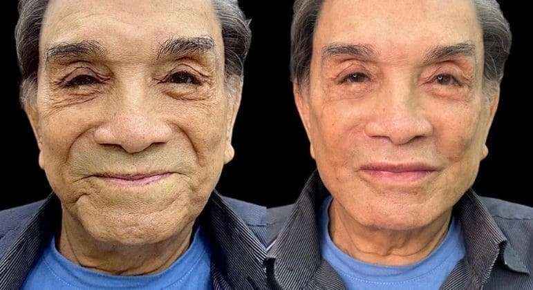 Dedé Santana passa por harmonização facial aos 86 anos