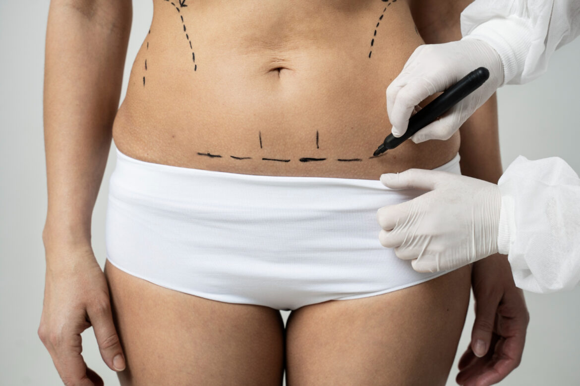 Lipoaspiração é a cirurgia estética mais realizada no mundo