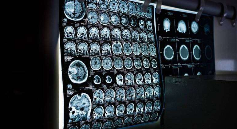 Cérebros de pessoas obesas têm prejuízos parecidos com os de quem tem Alzheimer