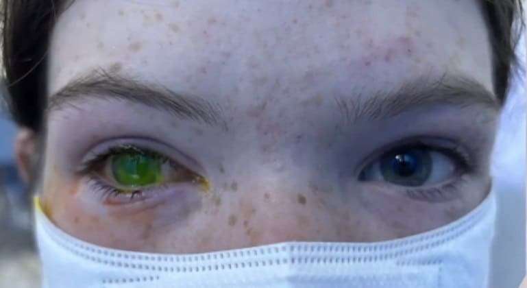 Austrália tem aumento do número de casos de doença que causa olhos verdes e dor equivalente à de parto