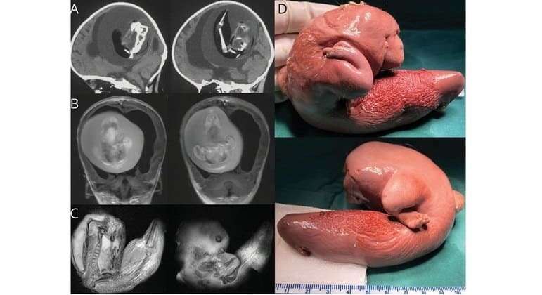 Bebê de 1 ano tinha feto de irmã gêmea alojado no cérebro