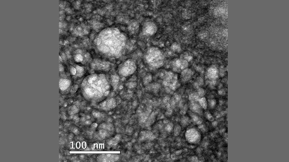 Cientistas conseguem eliminar tumor no cérebro com tratamento sem efeitos colaterais