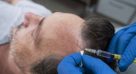 Gasto com transplante e implante de cabelo sobe 60% em um ano