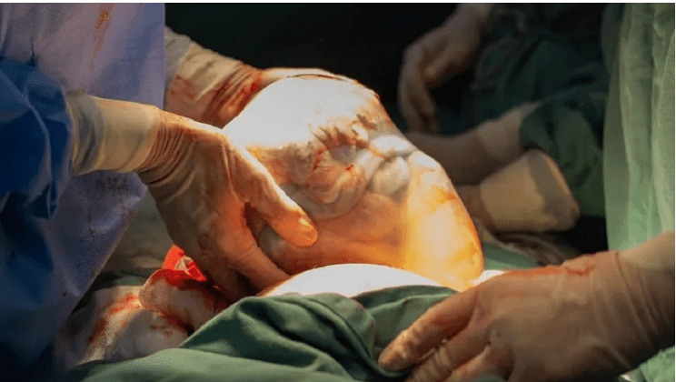 Parto raro: bebê nasce dentro da bolsa de líquido amniótico em Santa Catarina