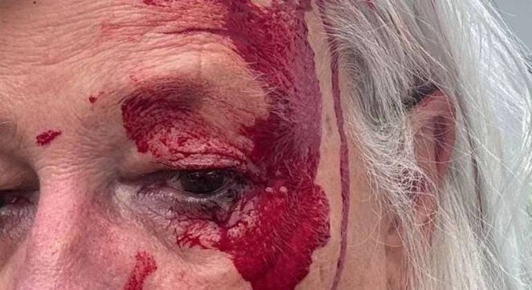 "Pensei que um tijolo tivesse caído na minha cabeça", diz aposentada atacada por gaivota