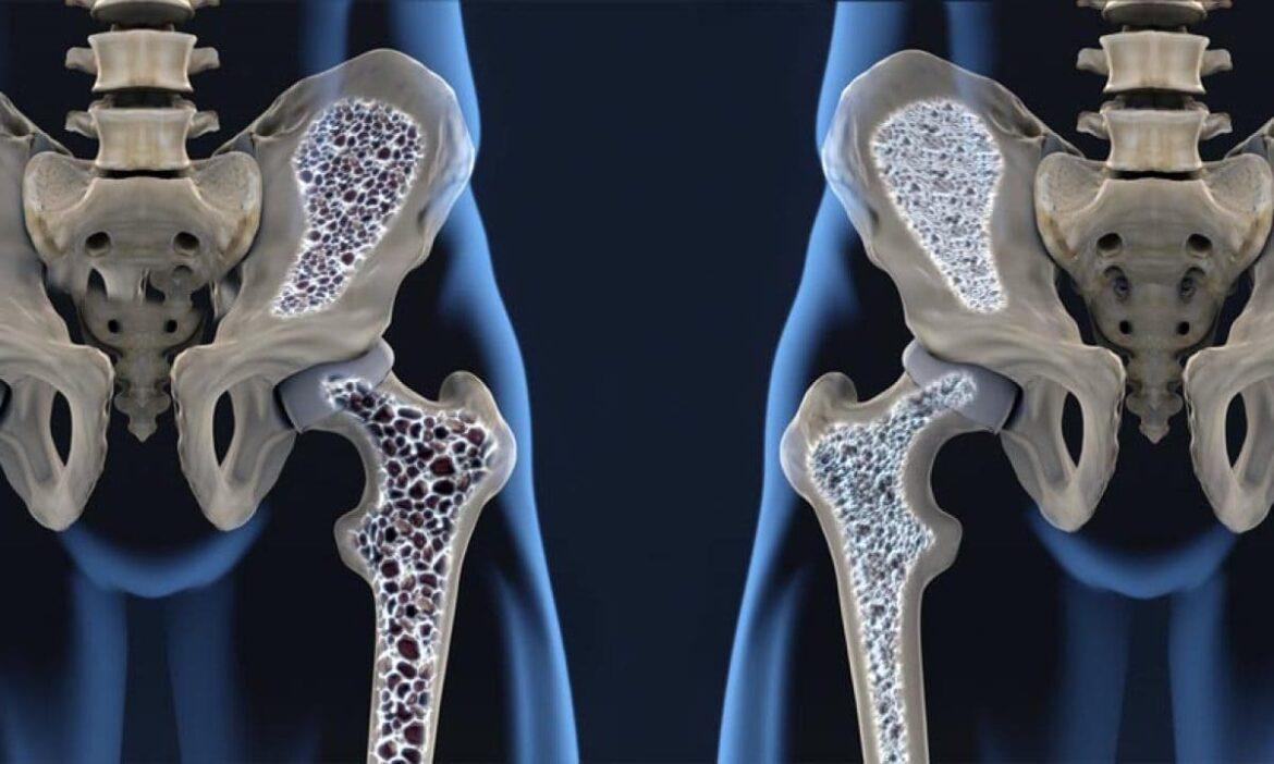 No dia Mundial da Osteoporose, endocrinologista explica sobre os principais sintomas e tratamento da doença