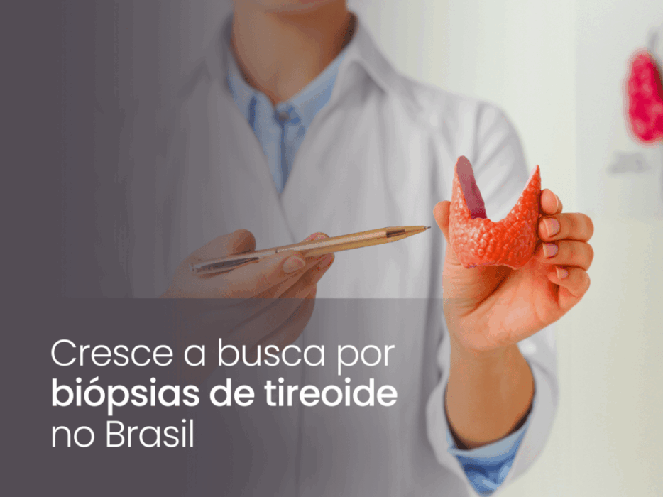 Cresce a busca por biópsias de tireoide no Brasil