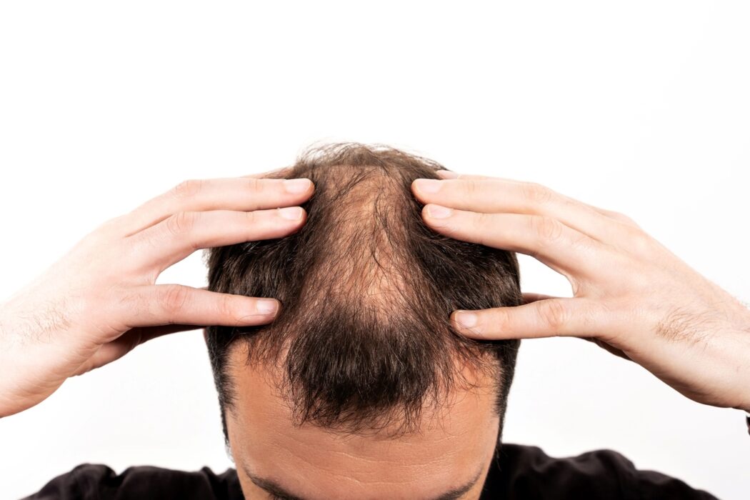 Alopecia: técnicas de tricologia podem oferecer soluções