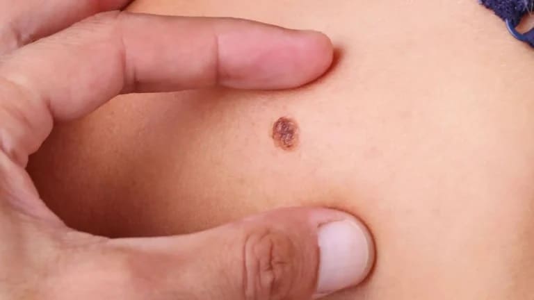 A importância da prevenção do câncer de pele e orientações sobre sintomas e cuidados.