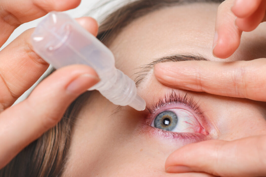 Tratamento da rosácea ocular avança com uso de tecnologia